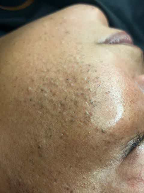 Acne & Pimples Brightening Facial