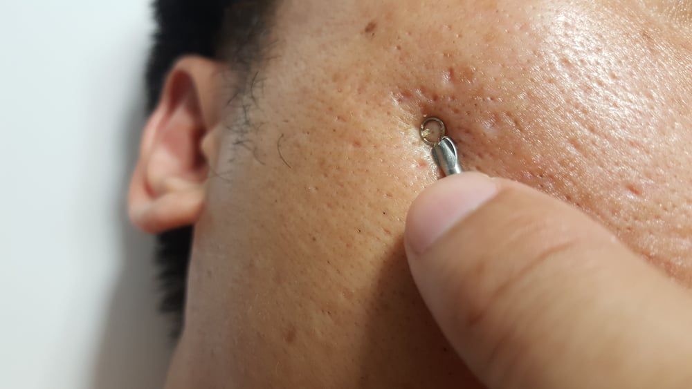 Acne & Pimples Brightening Facial